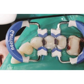 Garrison FXH300 Composi-Tight 3D Fusion Firm матрици Molar w/Extension, 6.1 mm