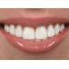 White smile After Whitening mousse 3 мл- десензибилизиращ гел преди и след избелване
