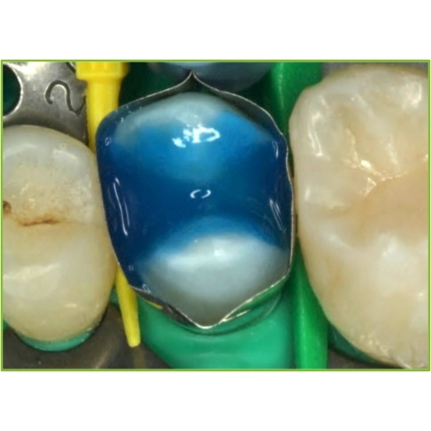 Gluma Total Etch 2.5 ml - ецващ гел за тотално ецване на дентина и емайла