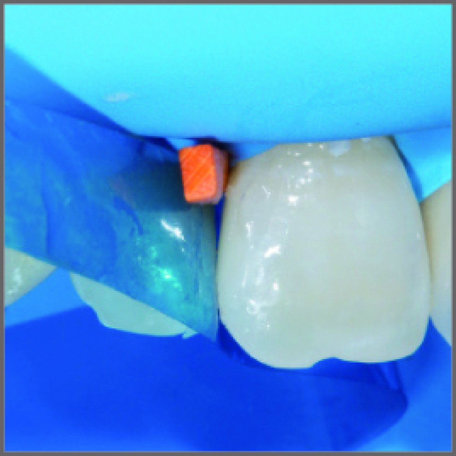 Garrison VS03 VariStrip anterior матрици 20 бр