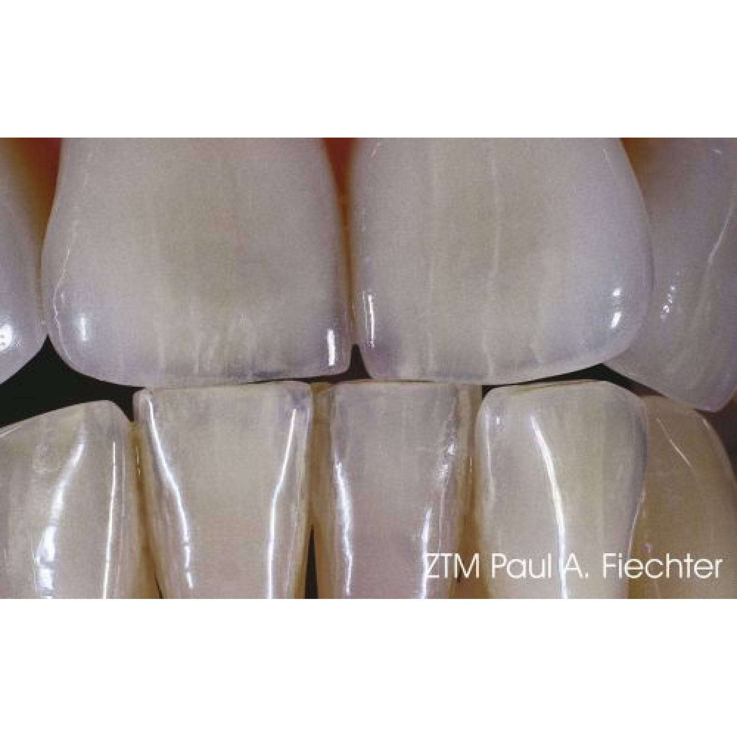 Heraceram Zirconia - за инкрустиране на конструкции от циркония Matrix set